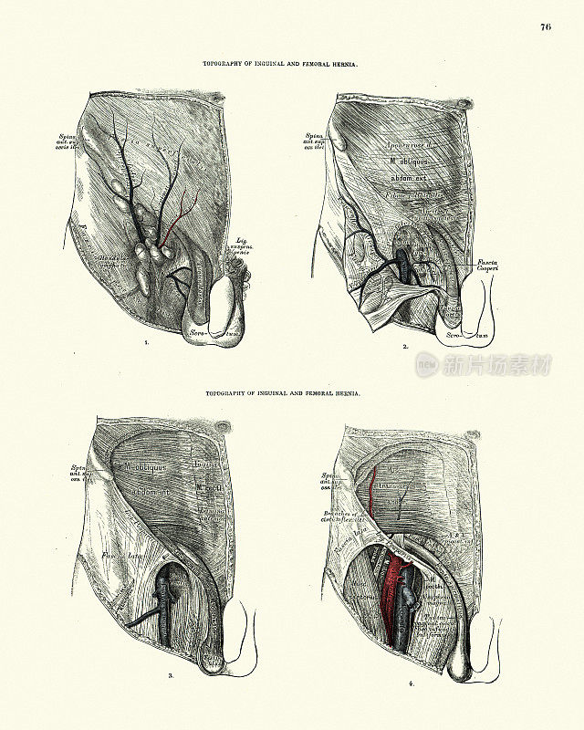 解剖学，腹股沟疝和股疝地形图，十九世纪维多利亚时代的解剖学图