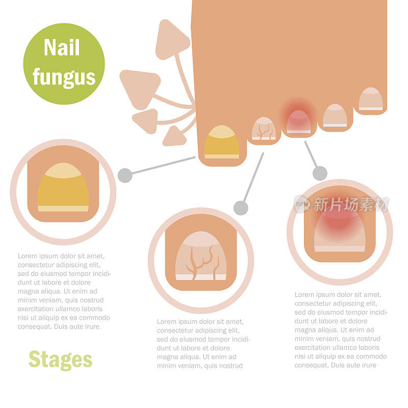 指甲真菌感染。