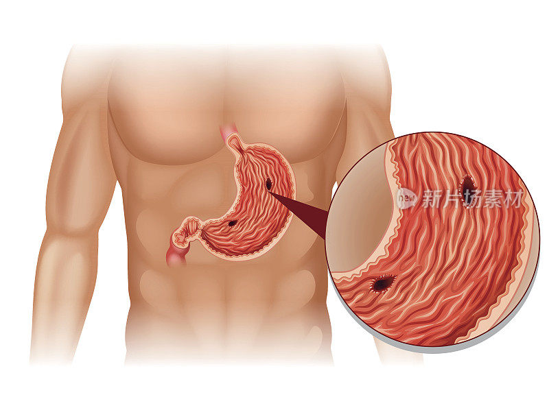 胃溃疡人体