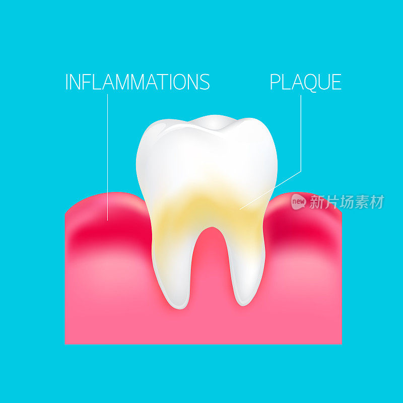 人类牙齿上的牙菌斑和牙龈发炎信息图表。