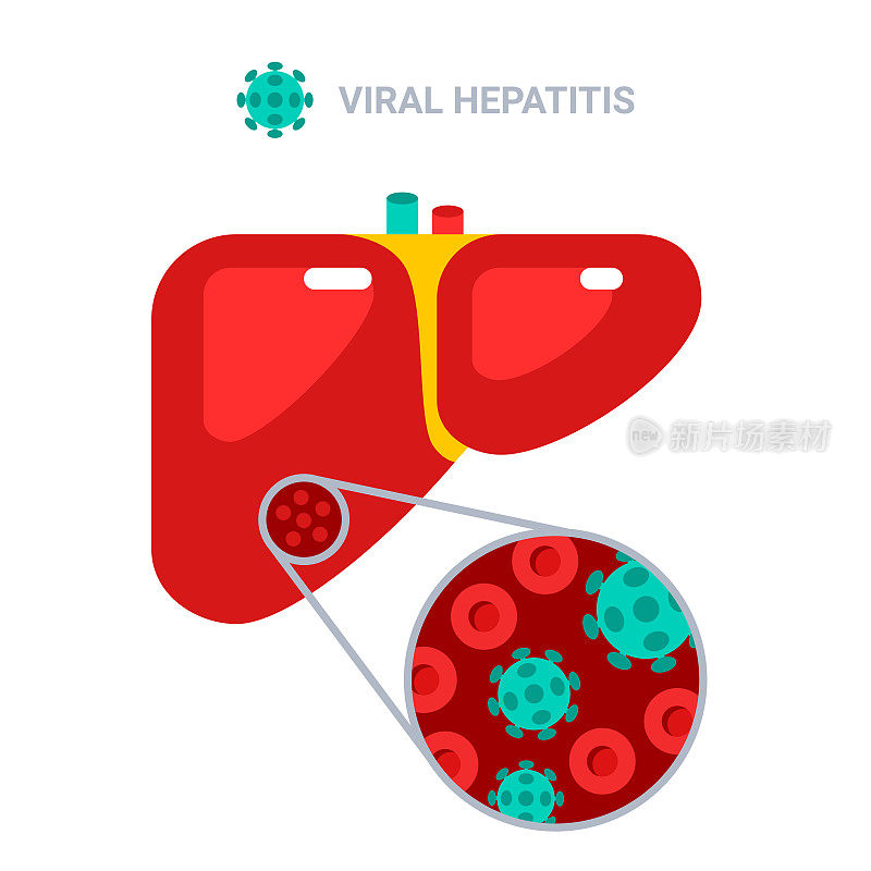病毒性肝炎概念海报