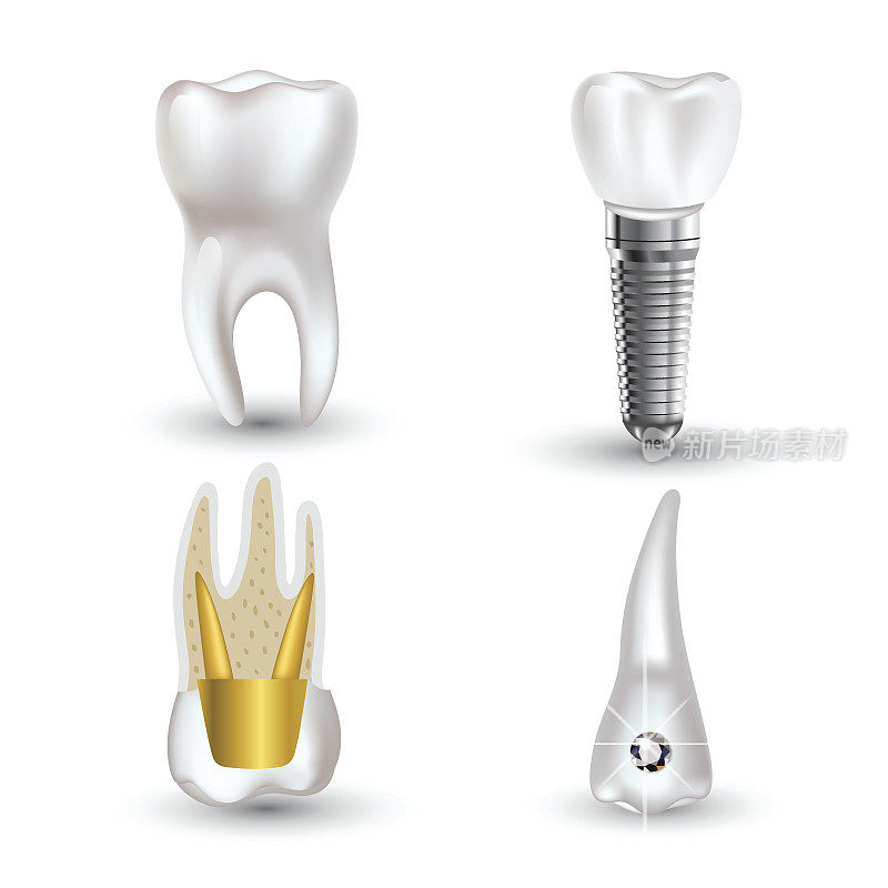 矢量集的3d现实清洁和肮脏的牙齿孤立在白色的背景。牙齿健康的概念。口腔护理，牙齿修复