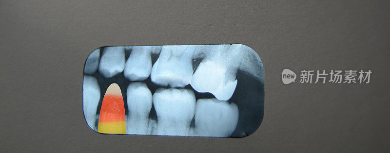 牙科x光片里的糖果