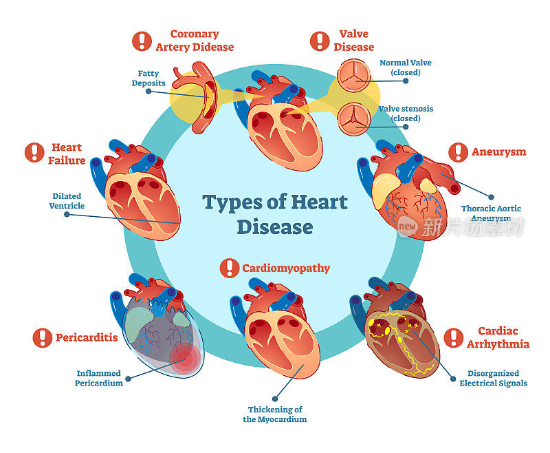 心脏病类型收集，矢量图解。