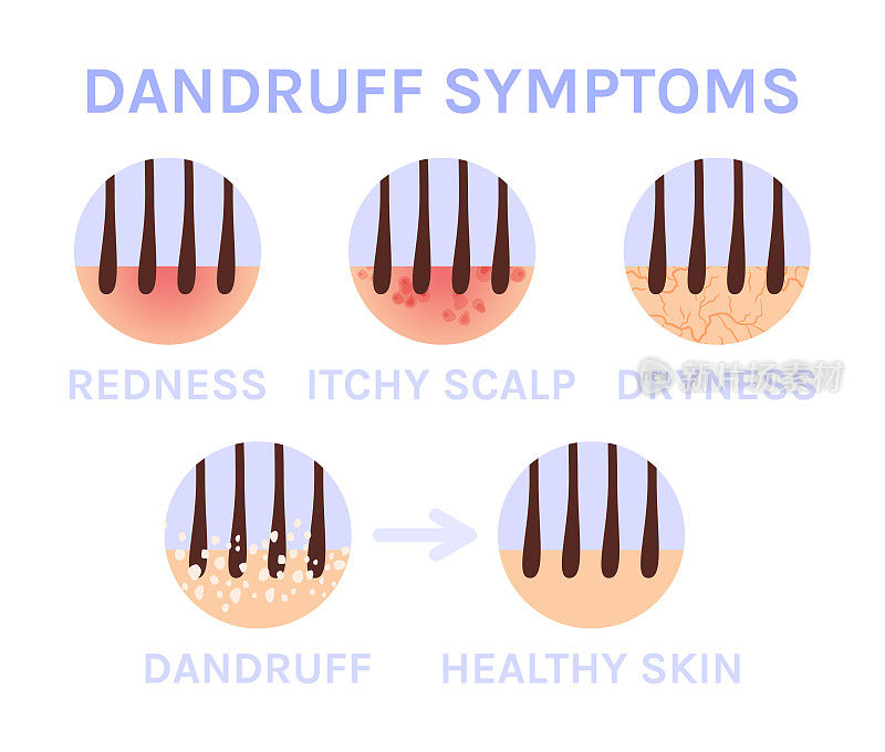头皮屑和图标。变焦。头发的问题。症状。头皮干燥、发红、发痒。特写镜头。治疗。之前和之后。彩色卡通风格。白色背景。医学设计矢量插图。
