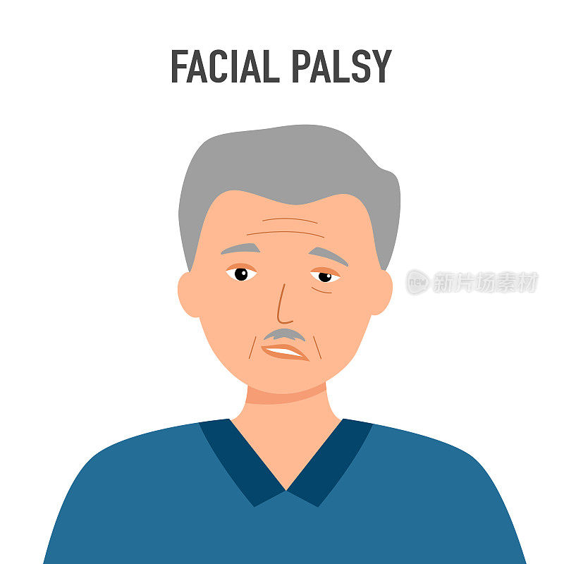 高级面神经麻痹概念矢量插图。面临瘫痪。