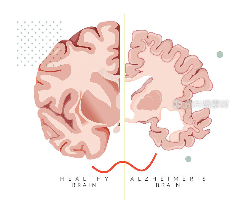 阿尔茨海默病-大脑横切面与健康大脑比较-插图