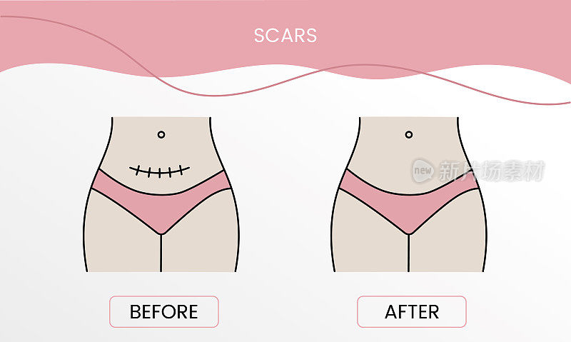 疤痕表面修复，手术前及手术后激光美容。一个女人与光滑的清洁皮肤和有问题的皮肤插图。