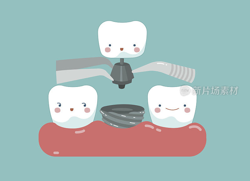 牙种植、牙和牙的概念