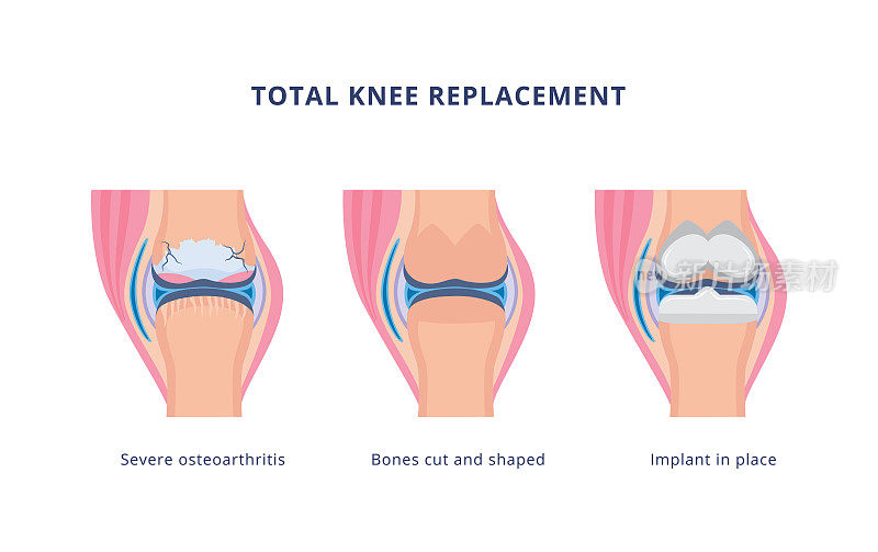 全膝关节置换术过程中，平面矢量图解孤立。
