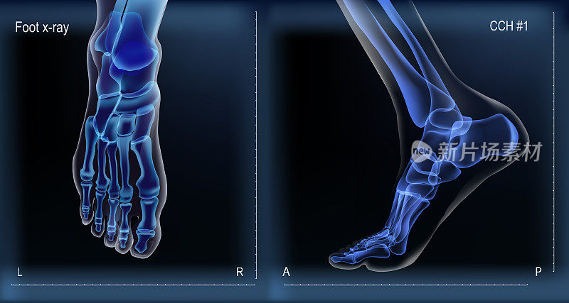 足部骨骼的x光片。