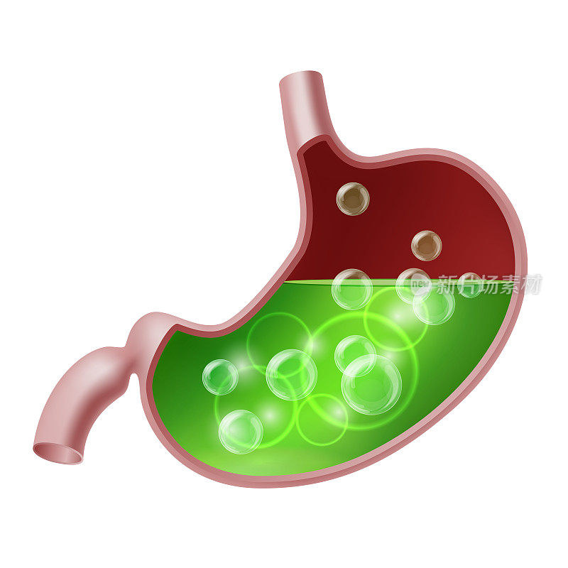 胃酸反流胃食管返流疾病。