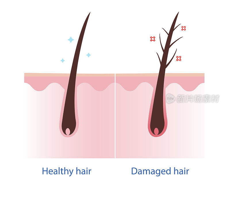 健康头发和受损头发头皮层向量在白色背景。