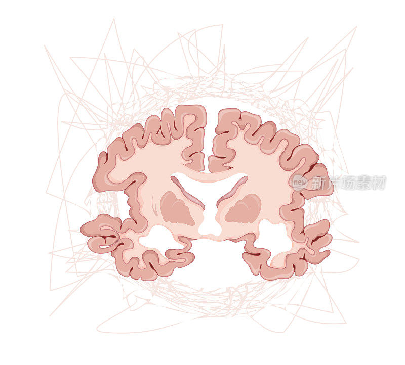 阿尔茨海默病-混淆-大脑横切面-插图