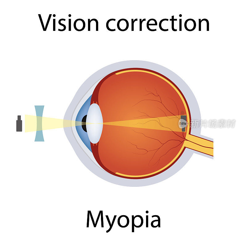 近视插图的视力矫正。视力障碍。通过凹透镜的概念矫正眼睛缺陷。近视眼缺损的详细解剖。孤立的向量