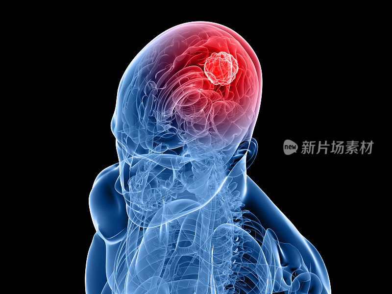 一幅描绘癌症的人类头骨和大脑的3d图像