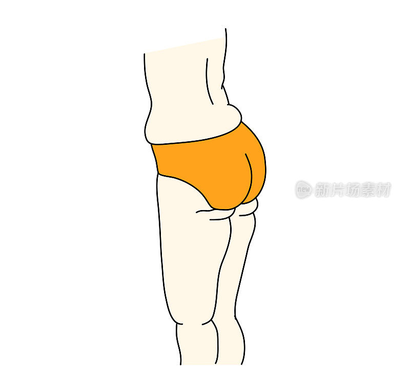 这是一个变形臀部区域的插图。
