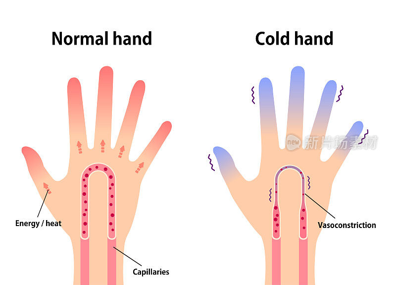 正常手与冷手对比图(对冷的敏感性，冷的指尖)