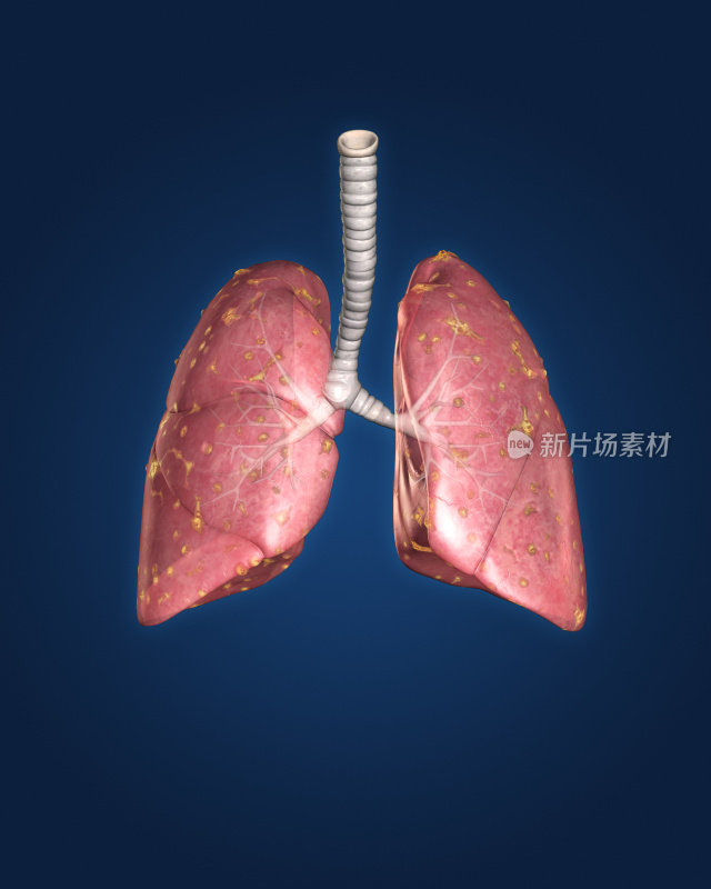 蓝色背景下分离的感染肺