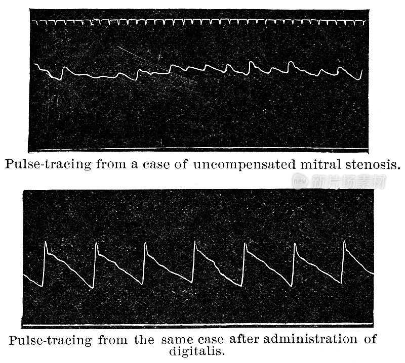 19世纪毛地黄治疗前后二尖瓣狭窄性心脏病的脉搏描记器