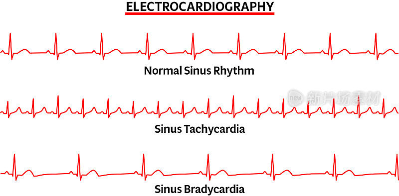 心电图常见异常-窦性心律正常-窦性心动过速-窦性心动过缓