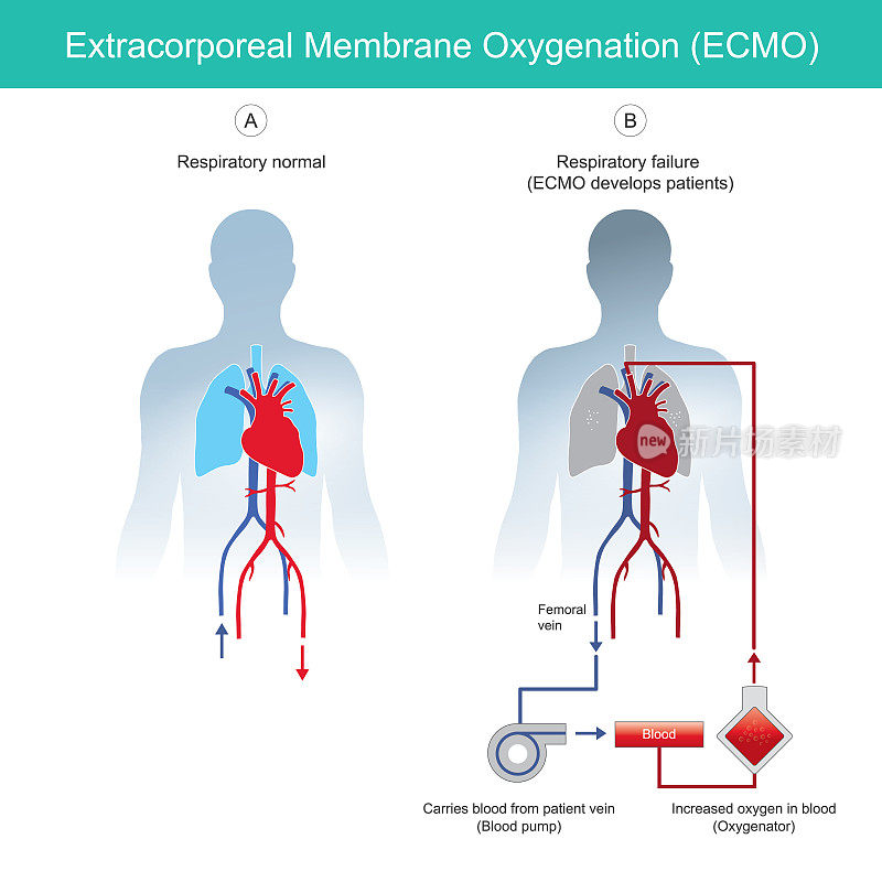 体外膜肺氧合。图解解释仪器体外膜氧合ECMO抢救患者呼吸衰竭。“n