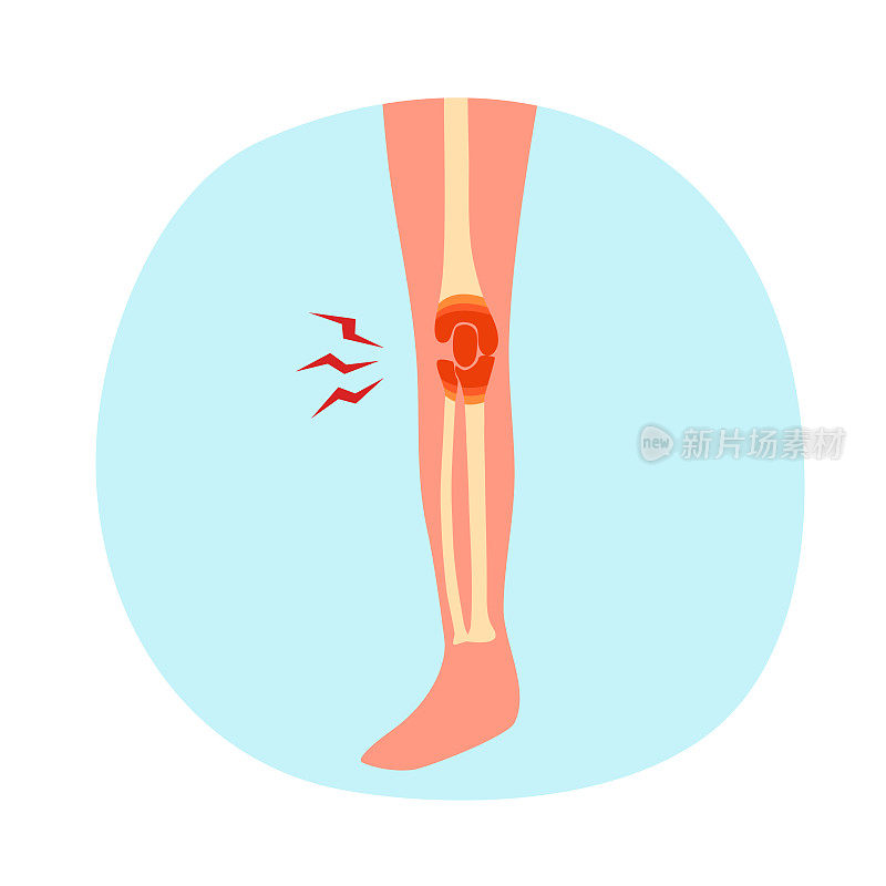 关节炎关节疼痛概念矢量插图。人的膝盖疼痛。