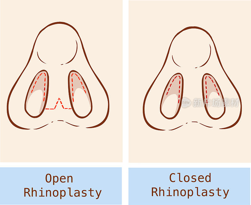 解剖学鼻整形术的矢量图解