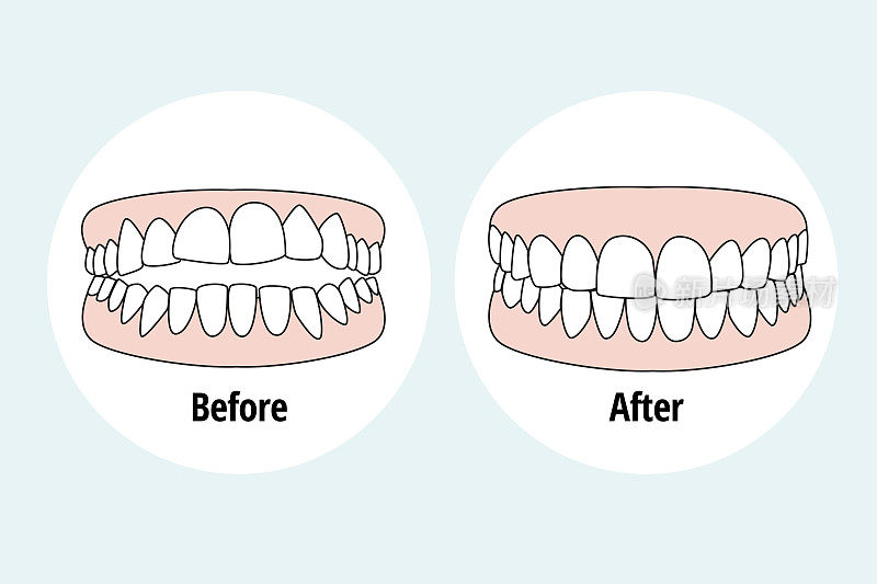 咬合不正拥挤。牙科问题矢量说明。牙科保健的概念。