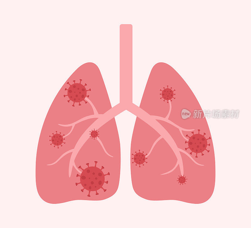 人体肺与病毒细胞肺部感染概念