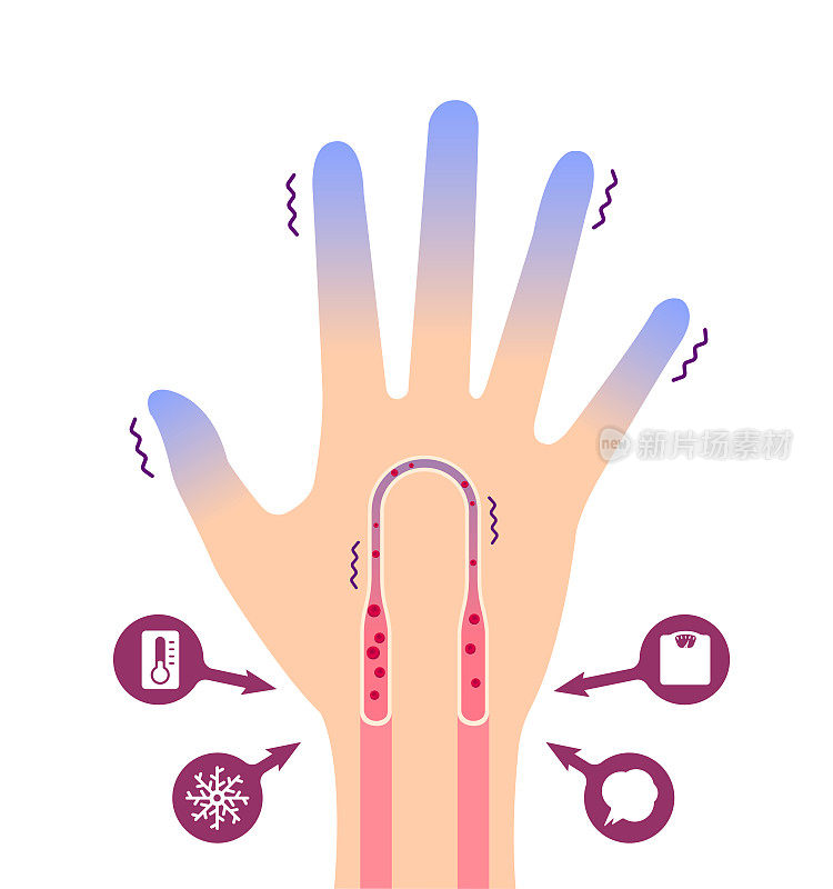 手冷血循环图(对寒冷敏感，指尖冷)
