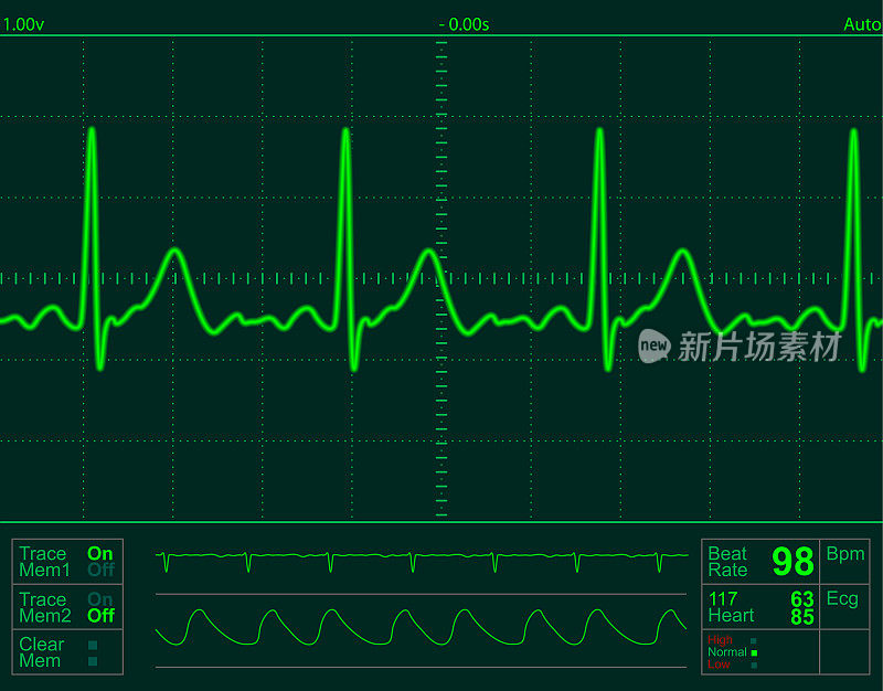 心脏监视器屏幕上