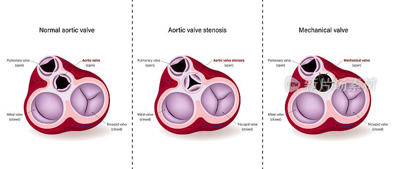 正常主动脉瓣、主动脉瓣狭窄和机械瓣示意图。主动脉瓣修复。主动脉瓣置换。