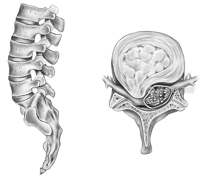 脊柱-椎间盘破裂