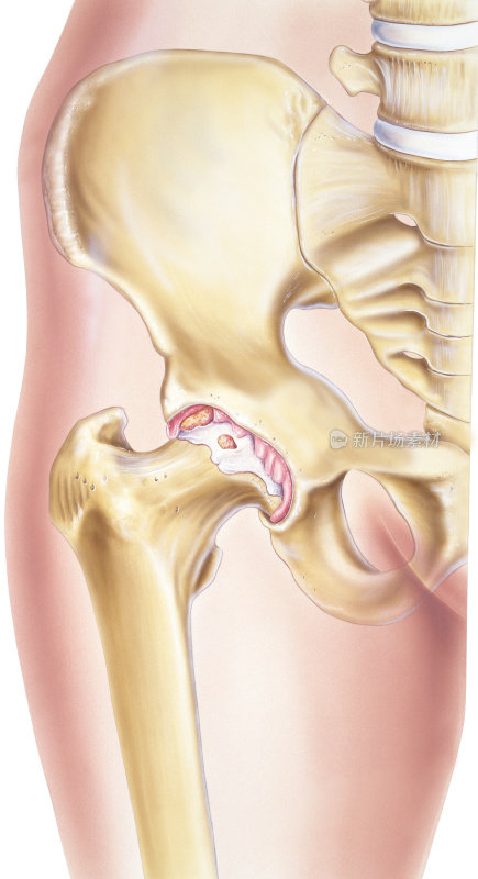 髋关节-关节的骨关节炎