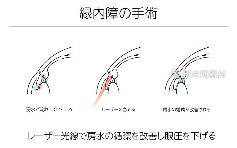 插图，青光眼手术，医学插图