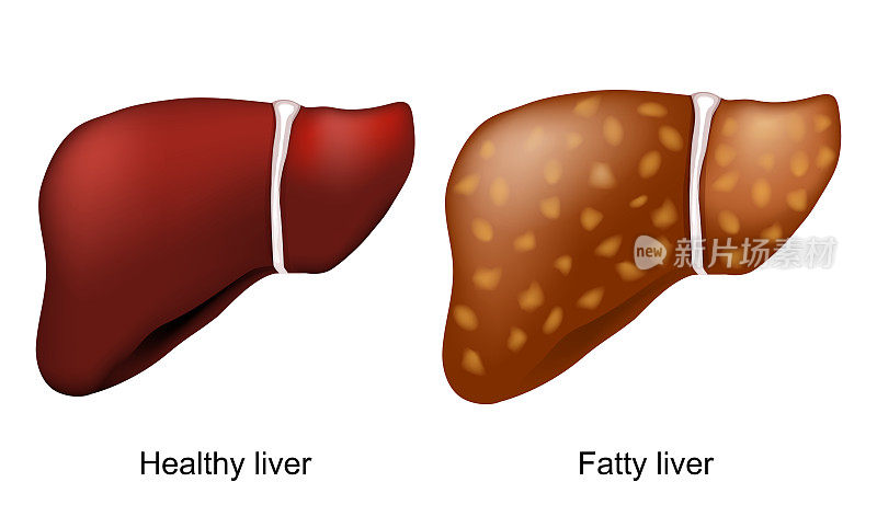 脂肪肝。健康肝脏和肝脏脂肪变性。