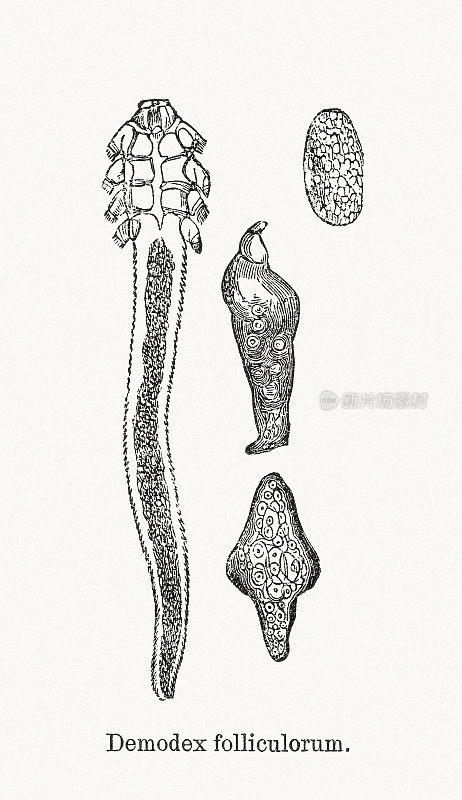 毛囊螨(毛囊蠕形螨)木版，1893年出版