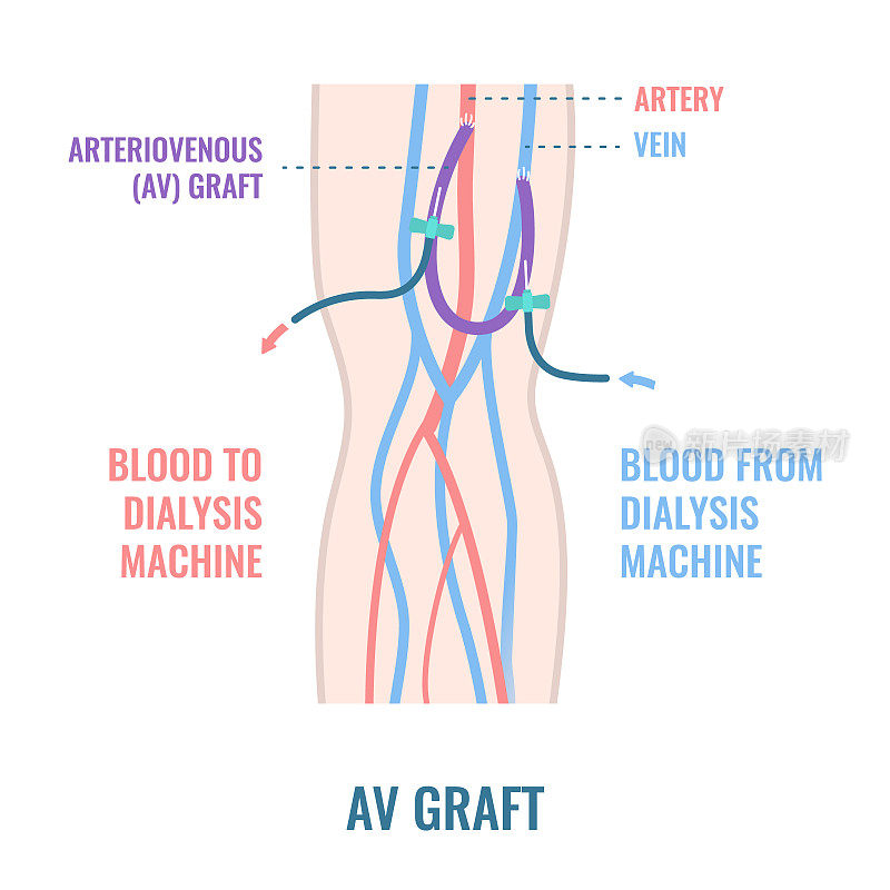 手臂动静脉透析分流移植物导管