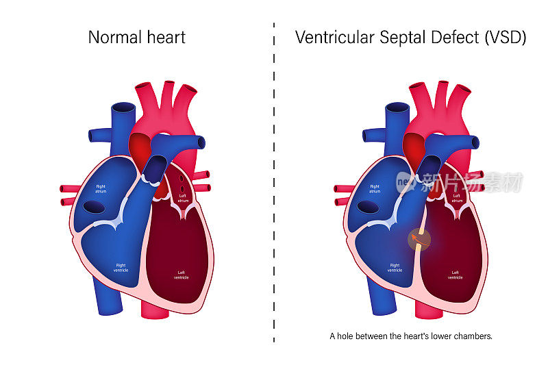 正常心脏与室间隔缺损载体的差异。先天性心脏缺陷。
