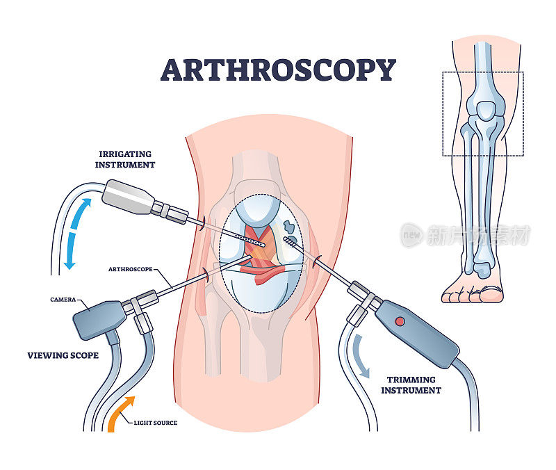 关节镜检查作为膝关节诊断过程的解释大纲图