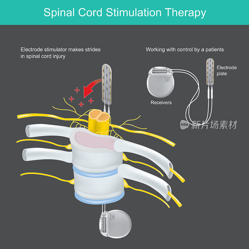 脊髓刺激疗法。一种用于治疗颈部和背部疼痛的体内植入电子工具。