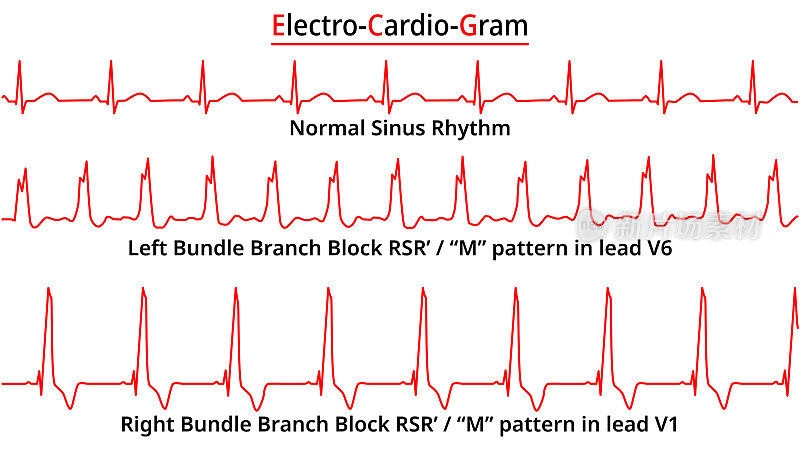 一组常见心电图异常-左束支传导阻滞vs右束支传导阻滞-正常窦性心律
