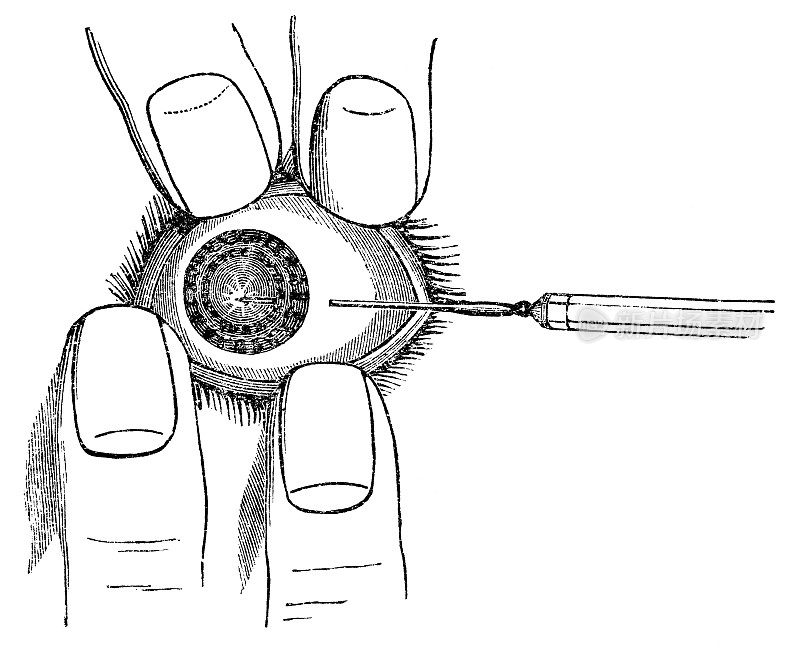 19世纪在人眼上进行白内障手术的医学插图