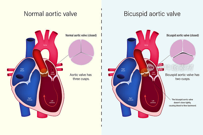 正常心脏瓣膜与二尖瓣主动脉瓣载体的差异。先天性心脏病。主动脉瓣返流。