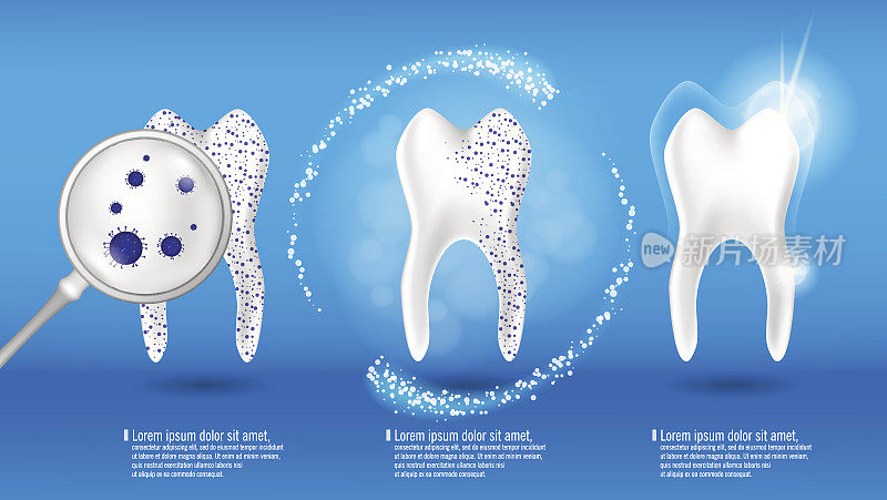 口腔护理和牙齿健康概念。闪亮清洁和脏牙在蓝色背景上，清除牙齿过程。牙齿美白修复。矢量图