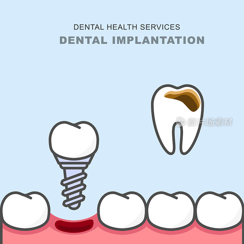 牙齿种植代替龋齿修复