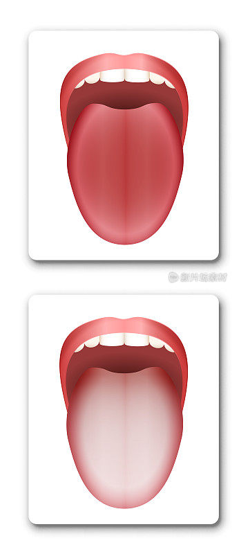 通过比较清洁健康舌和舌苔白舌-在白色背景上孤立矢量图。