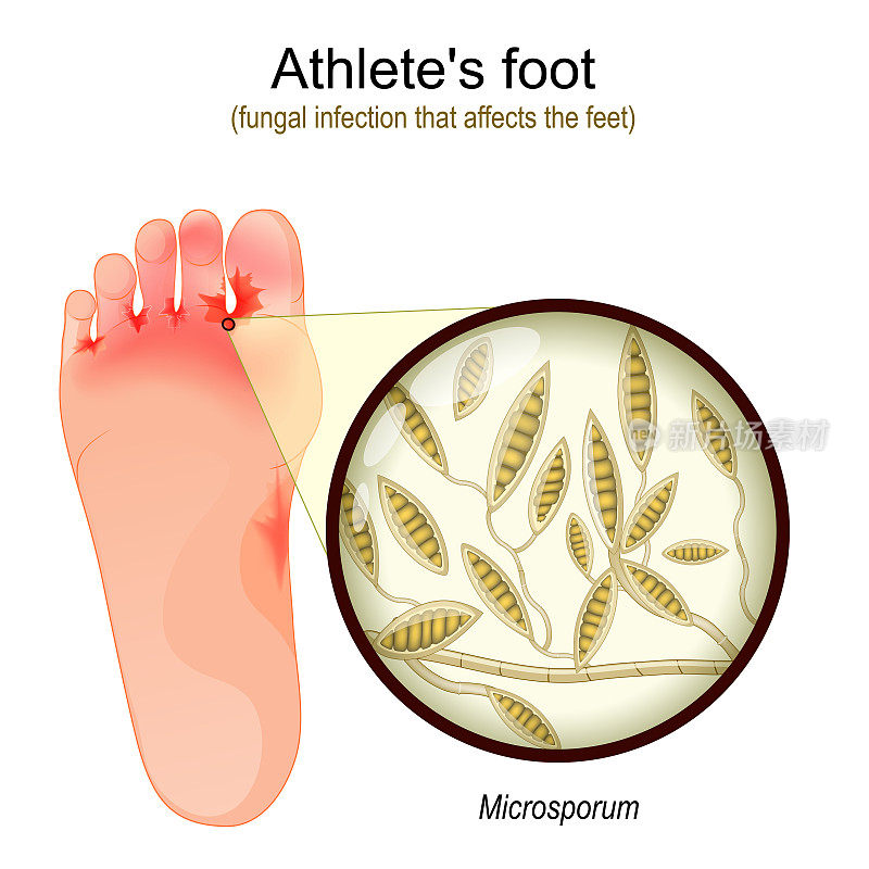 脚气。真菌感染影响足部。