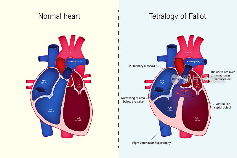 正常心脏与法洛四联症的差异。先天性心脏病。